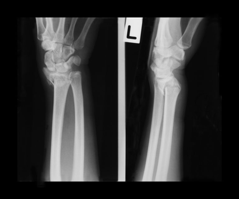 Wrist Fracture Zaf Naqui