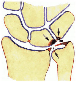 Zaf Naqui | Triangular Fibrocartilage Complex (TFCC) tear ...