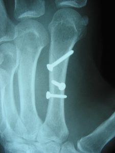 metacarpal fracture surgery with screws