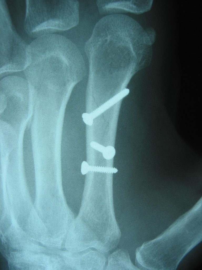 Zaf Naqui Fractures of the metacarpal bones