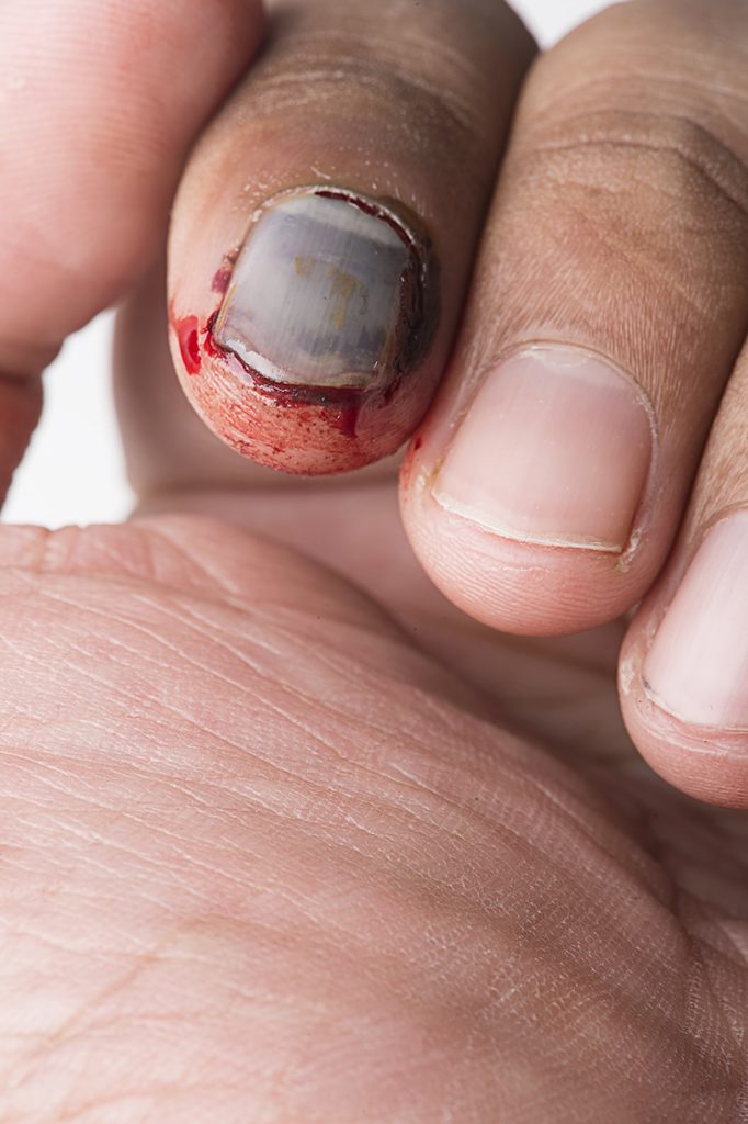 Nail Bed Injury - Zaf Naqui