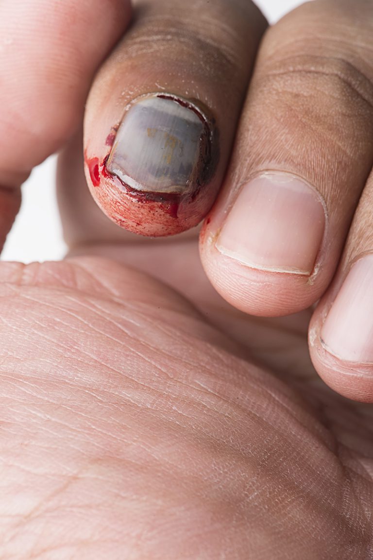 What To Do When Nail Rips Off Nail Bed